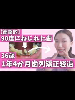 [画像][x]36歳|1年4か月経過報告【歯列矯正経過 余白なし