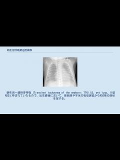[画像][x]新生児呼吸窮迫症候群 - YouTube 余白なし