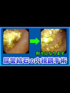 [画像][x]腎臓結石・尿管結石に対する経尿道的内視鏡治療(TUL) #尿管結石 #泌尿器科 #TUL - YouTube 余白なし