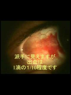 [画像][x]結膜下出血 - YouTube 余白なし