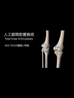[画像][x]人工膝関節置換術・TKAの種類と特徴 - YouTube 余白なし