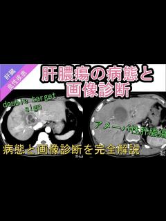 [画像][x]肝膿瘍の病態と画像診断 - YouTube 余白なし