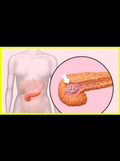 [画像][x]すい臓がんを疑う5つの初期症状 - YouTube 余白なし