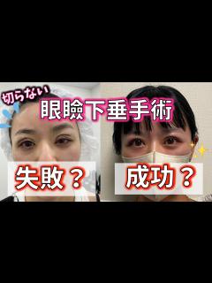 [画像][x]切らない眼瞼下垂の手術【失敗？ 余白なし