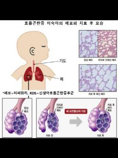 [画像][x]미숙아 호흡곤란증후군 치료 합성신약 개발 余白なし