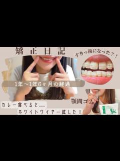 [画像][x]矯正1年~1年半の変化/額間ゴム/奮闘記録🔥 - YouTube 余白なし